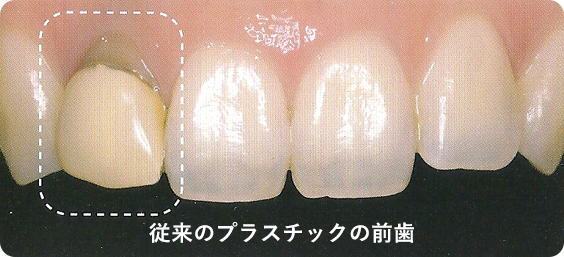 従来のプラスチックの前歯