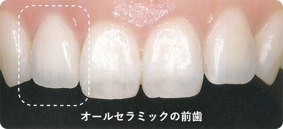 オールセラミックの前歯