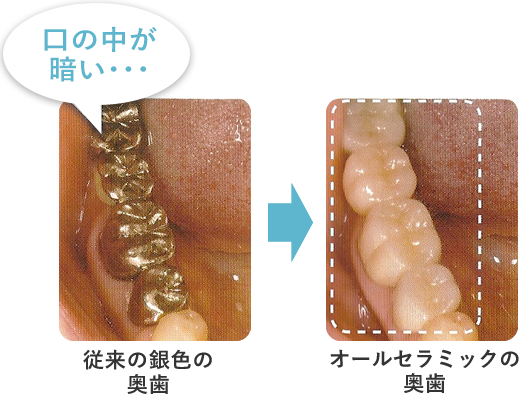 オールセラミックの奥歯