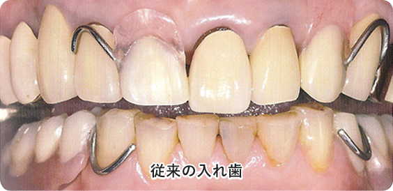 従来の入れ歯