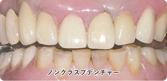 ノンクラスプデンチャー